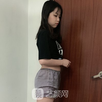 南京美贝尔整形医院吸脂好不好？体验对比图公开