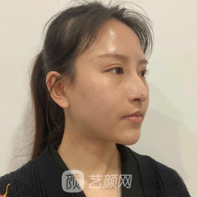 嘉兴曙光美容医院隆鼻实例出炉|80天体验成果图出炉