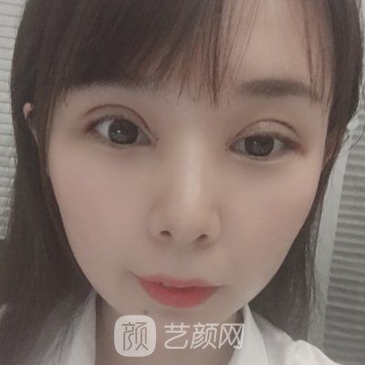 成都素美杨迪做双眼皮怎么样?2023新版实例出炉