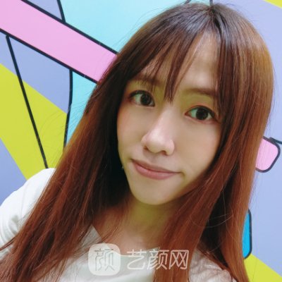 广州曙光美容医院乔雅登面部填充实例发布|附体验对比图