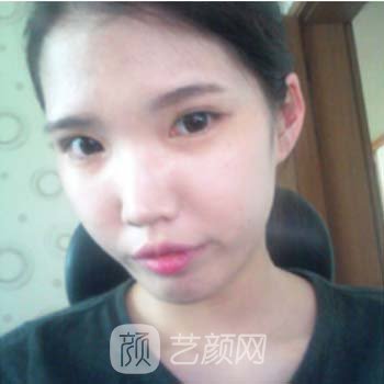高俊明医生隆鼻整形实例，让我比以前更加的美丽~