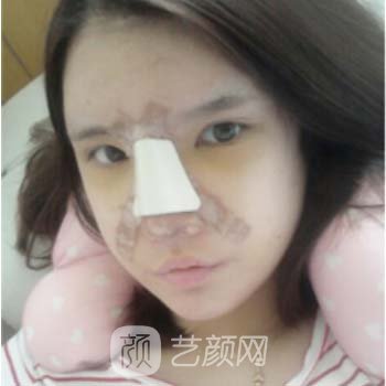 高俊明医生隆鼻整形实例，让我比以前更加的美丽~