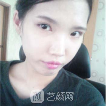 高俊明医生隆鼻整形实例，让我比以前更加的美丽~