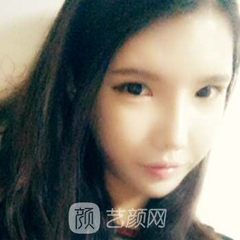 高俊明医生隆鼻整形实例，让我比以前更加的美丽~