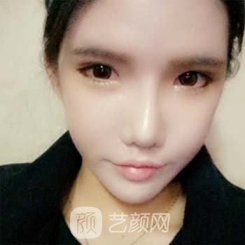 高俊明医生隆鼻整形实例，让我比以前更加的美丽~