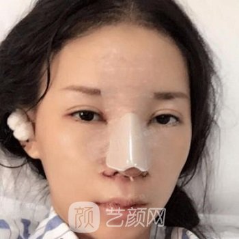 徐庶隆鼻实例，鼻子自然立挺，高度和线条感很满意~