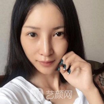 徐庶隆鼻实例，鼻子自然立挺，高度和线条感很满意~