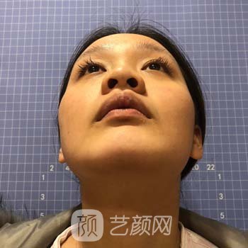 朱晓波隆鼻实例，面部轮廓都变好看了，五官看着很协调~