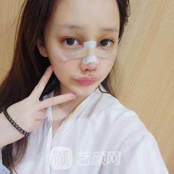 朱晓波隆鼻实例，面部轮廓都变好看了，五官看着很协调~