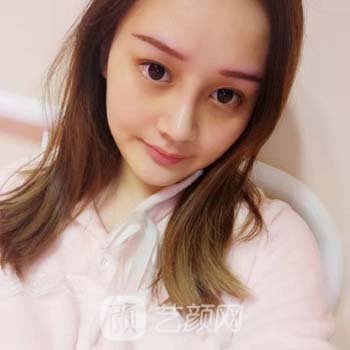 朱晓波隆鼻实例，面部轮廓都变好看了，五官看着很协调~