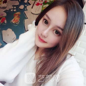 朱晓波隆鼻实例，面部轮廓都变好看了，五官看着很协调~