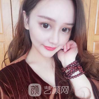 朱晓波隆鼻实例，面部轮廓都变好看了，五官看着很协调~