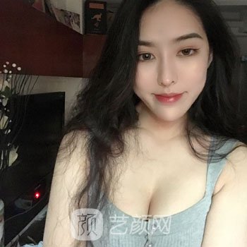 赵延勇假体隆胸实例，修复到了以前的自信，拥有了魔鬼般的身材