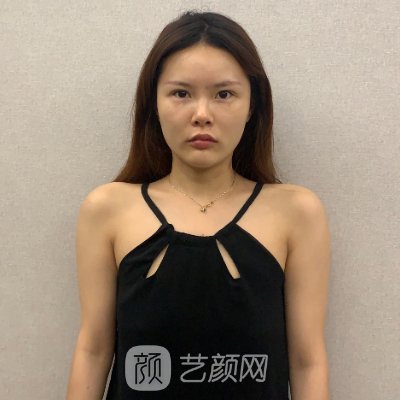 台江海峡林沸腾医生隆胸成果图曝光|成果自然美观