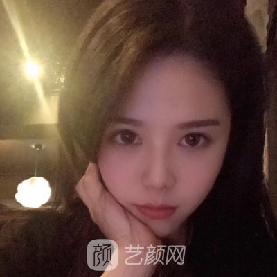 上海欧莱美医疗美容医院正规吗?2023全新双眼皮实例展示