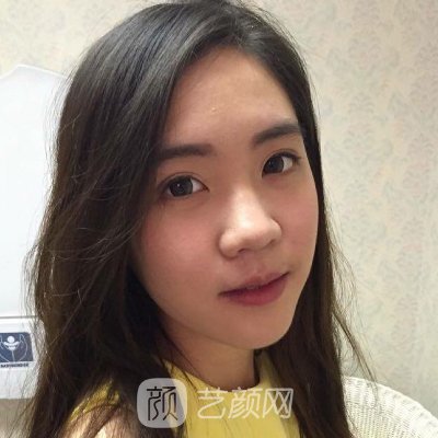 天津美莱医院李锦卓面部脂肪填充实例展示|附体验对比图