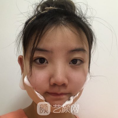 上海港华医院磨骨靠谱吗？医院实力及实例曝光