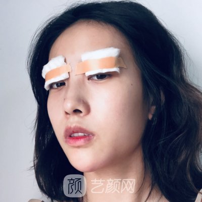 成都米亚整形医院正规吗？全新双眼皮体验实例公开