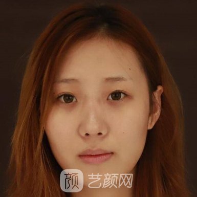 西安画美杨万忠做鼻子怎么样?2023招牌实例公开