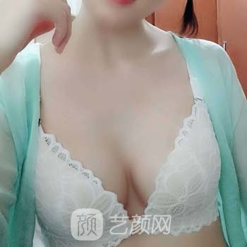 陈育哲隆胸下皱襞实例，术后可以穿很性感的衣服，美极了