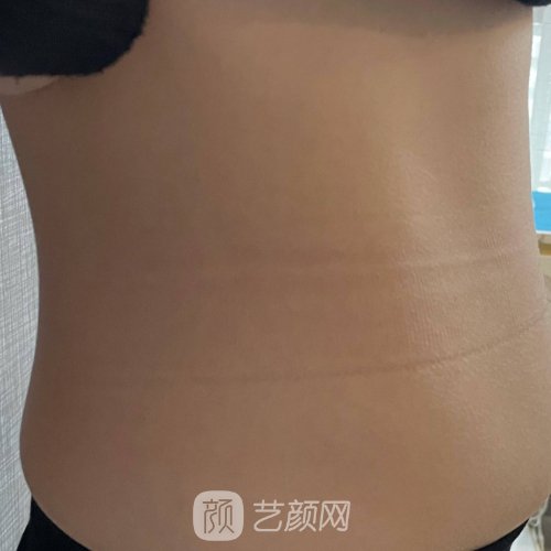 上海联合丽格吸脂成果怎么样？医院招牌实例公开