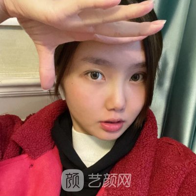 沈阳杏林美容整形医院面部吸脂实例曝光｜成果自然美观