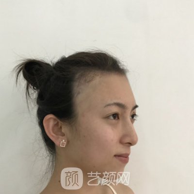 长沙美莱植发靠谱吗？｜全新发际线种植实例公开