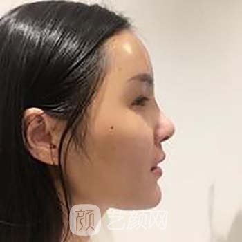 Vline+全脸面部填充整形修复成果真人实例，丑小鸭的逆袭之路