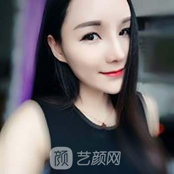Vline+全脸面部填充整形修复成果真人实例，丑小鸭的逆袭之路