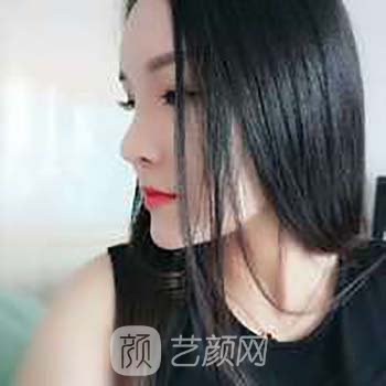 Vline+全脸面部填充整形修复成果真人实例，丑小鸭的逆袭之路