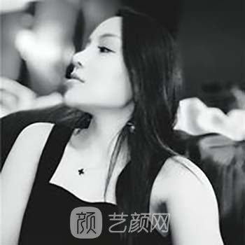 Vline+全脸面部填充整形修复成果真人实例，丑小鸭的逆袭之路
