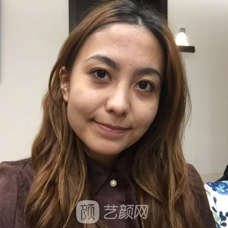 泉州美莱华美整形医院靠谱吗?全新面部提升实例分享