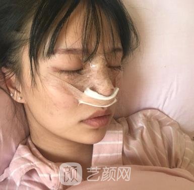 郭伶俐隆鼻实例，医生用不错的技术让我变得更加美丽~