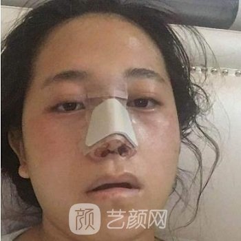 铜雀台周珂隆鼻失败修复实例，找技术不错的医生果然不一样