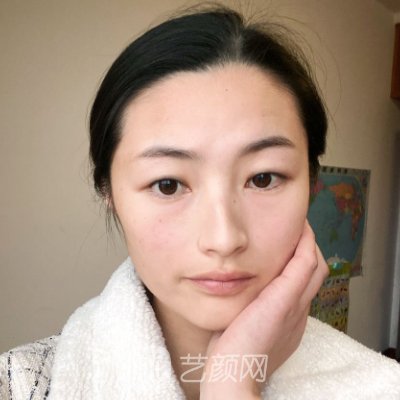 广州美莱陈贵宗割双眼皮好吗?全新体验实例出炉