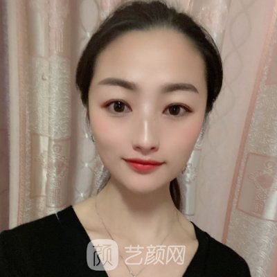 广州美莱陈贵宗割双眼皮好吗?全新体验实例出炉