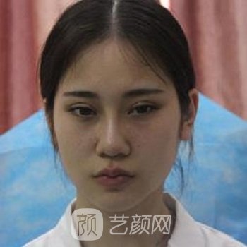 华人医联院黄文隆鼻实例，一下子就变成了精致的猪猪女孩