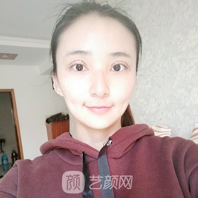 太原华美整形美容医院正规吗?2023双眼皮整形实例展示