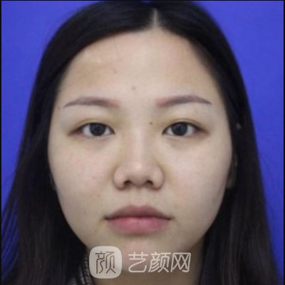 福州比华利美容医院正规吗?新版隆鼻实例曝光