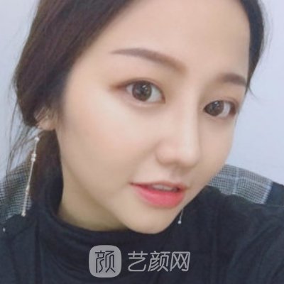 福州比华利美容医院正规吗?新版隆鼻实例曝光