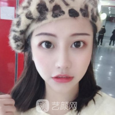 福州比华利美容医院正规吗?新版隆鼻实例曝光