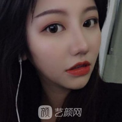 福州比华利美容医院正规吗?新版隆鼻实例曝光