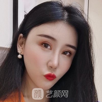 北京叶子整形美容医院正规吗?新版双眼皮整形实例曝光