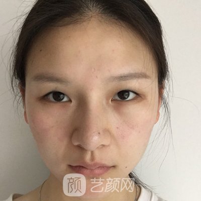 成都画美医疗美容医院怎么样?全新双眼皮整形实例发布