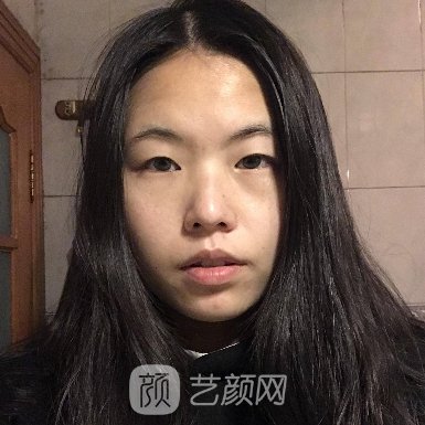 广州越秀紫馨曹仁昌医生割双眼皮怎么样?新版体验实例公开