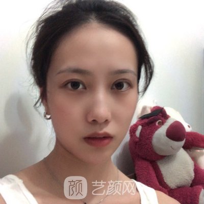 南昌艾莱芙美容医院正规吗?全新双眼皮整形实例分享