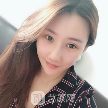 成都贾德渊隆鼻实例，术后变得更加自信了，整个人可爱又美丽