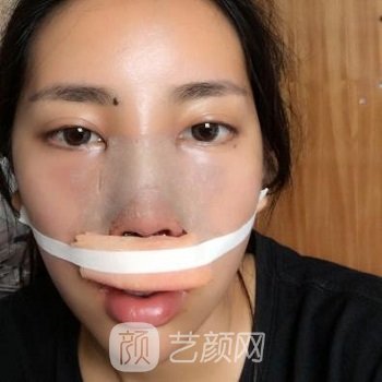 杏林朱石江隆鼻实例，修复后从侧面看弧度十分优美~