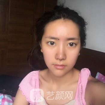 杏林朱石江隆鼻实例，修复后从侧面看弧度十分优美~