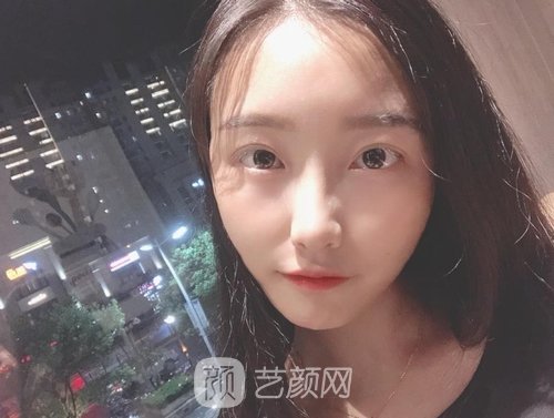 李湘原磨骨失败修复实例，医术不错帮我修复到自然的脸型~